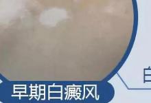 日常生活:怎樣區(qū)別是不是白癩風(fēng)