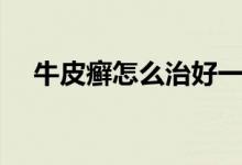牛皮癬怎么治好一點(diǎn)（牛皮癬怎么治好）