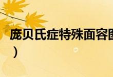 龐貝氏癥特殊面容圖片（龐貝氏癥是什么疾?。?class=