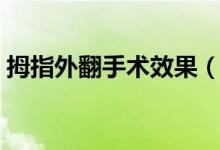 拇指外翻手術效果（拇指外翻手術效果好嗎）